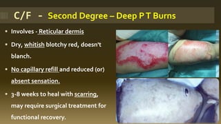 ▪ Involves - Reticular dermis
▪ Dry, whitish blotchy red, doesn't
blanch.
▪ No capillary refill and reduced (or)
absent sensation.
▪ 3-8 weeks to heal with scarring,
may require surgical treatment for
functional recovery.
C/F - Second Degree – Deep PT Burns
 