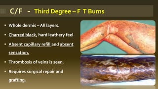 ▪ Whole dermis – All layers.
▪ Charred black, hard leathery feel.
▪ Absent capillary refill and absent
sensation.
▪ Thrombosis of veins is seen.
▪ Requires surgical repair and
grafting.
C/F - Third Degree – F T Burns
 
