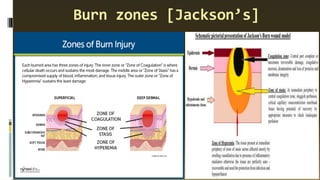 Burn zones [Jackson’s]
 