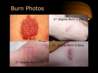 Slight Burn In BURNS.ppt BURNS.ppt BURNS.pptBURNS.ppt BURNS.ppt