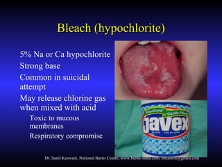 Burns- chemical and pediatric by Dr. Sunil Keswani, National Burns ...