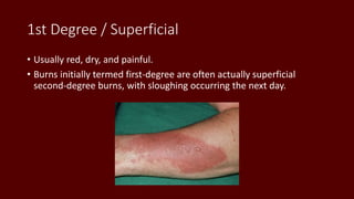 1st Degree / Superficial
• Usually red, dry, and painful.
• Burns initially termed first-degree are often actually superficial
second-degree burns, with sloughing occurring the next day.
 