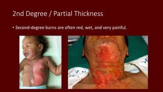 2nd Degree / Partial Thickness
• Second-degree burns are often red, wet, and very painful.
 