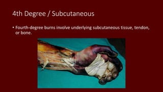 4th Degree / Subcutaneous
• Fourth-degree burns involve underlying subcutaneous tissue, tendon,
or bone.
 