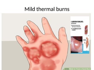 Mild thermal burns
 
