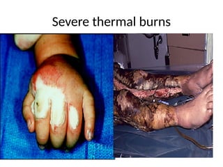 Severe thermal burns
 