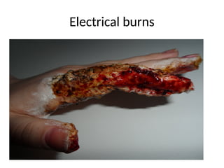 Electrical burns
 