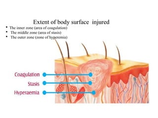 Extent of body surface injured
 The inner zone (area of coagulation)
 The middle zone (area of stasis)
 The outer zone (zone of hyperemia)
 