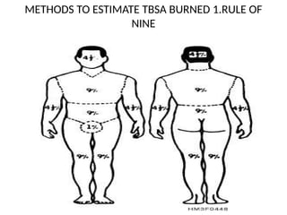 METHODS TO ESTIMATE TBSA BURNED 1.RULE OF
NINE
 