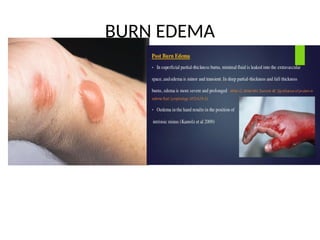 BURN EDEMA
 