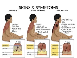 SIGNS & SYMPTOMS
•Small thin
blister •Thick walled
blister
•Dry leathery
skin
 