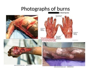 Photographs of burns
 