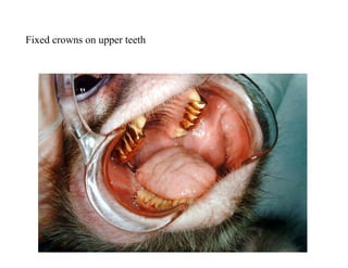 Fixed crowns on upper teeth
 