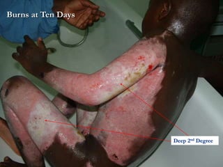 Burns at Ten Days
Deep 2nd Degree
 