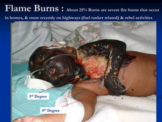 Flame Burns : About 25% Burns are severe fire burns that occur
in homes, & more recently on highways (fuel tanker related) & rebel activities
3rd Degree
4th Degree
 