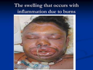 The swelling that occurs with
inflammation due to burns
47
 