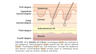 Comprehensive Overview of Burn Injuries: Types, Pathophysiology, and ...