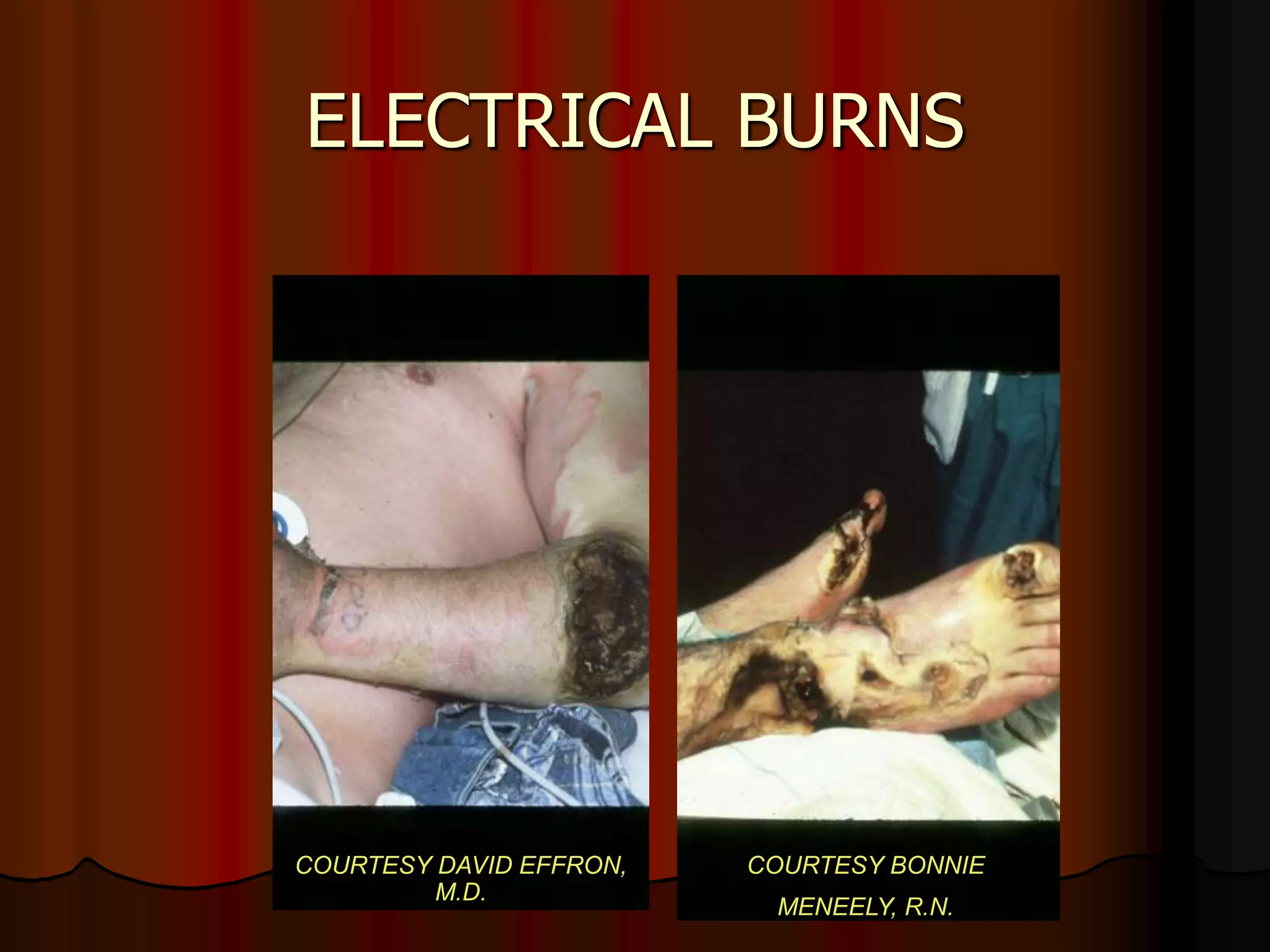 ELECTRICAL BURNS
COURTESY DAVID EFFRON,
M.D.
COURTESY BONNIE
MENEELY, R.N.
 