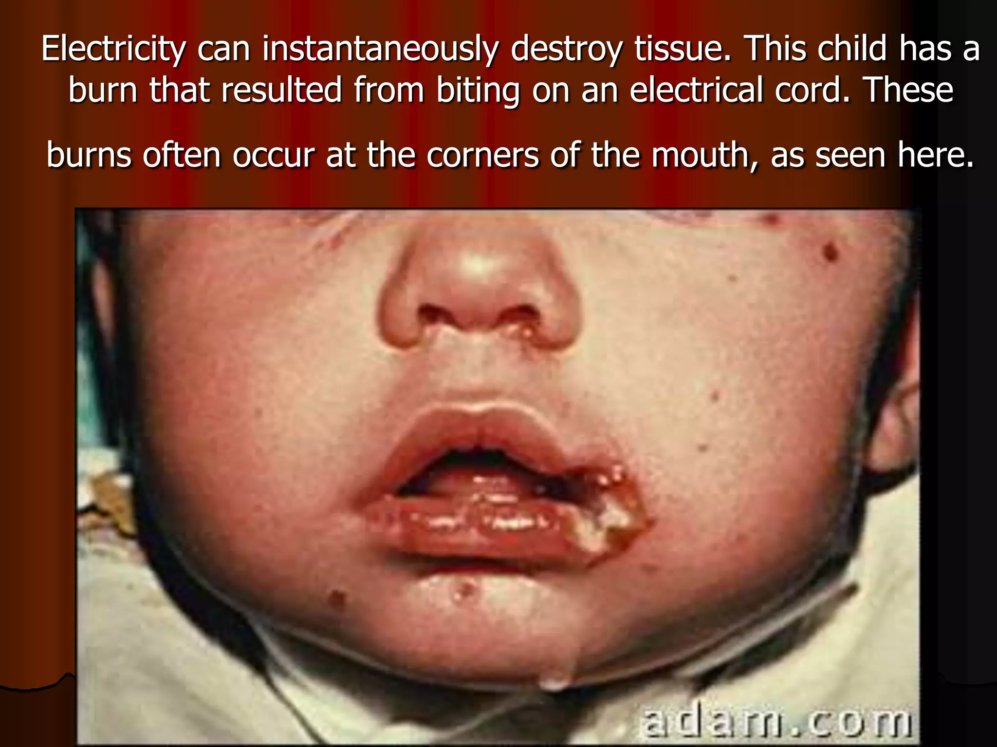 Electricity can instantaneously destroy tissue. This child has a
burn that resulted from biting on an electrical cord. These
burns often occur at the corners of the mouth, as seen here.
 