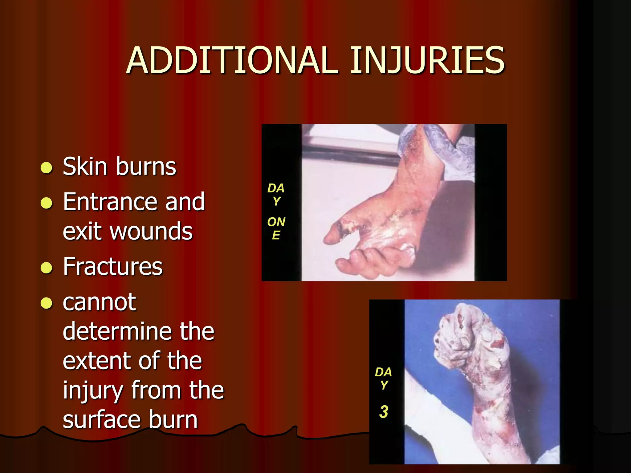 ADDITIONAL INJURIES
 Skin burns
 Entrance and
exit wounds
 Fractures
 cannot
determine the
extent of the
injury from the
surface burn
DA
Y
ON
E
DA
Y
3
 