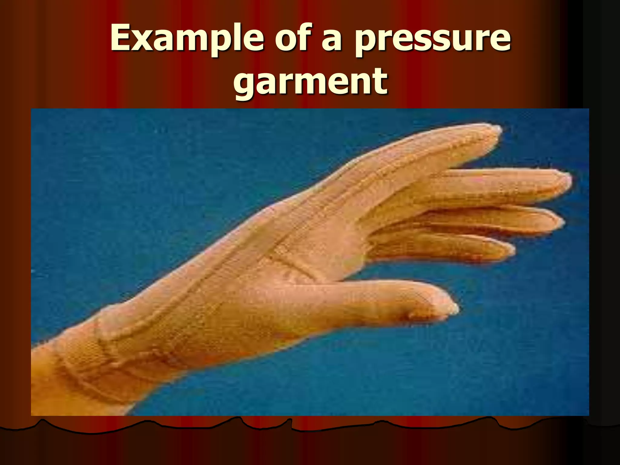Example of a pressure
garment
 