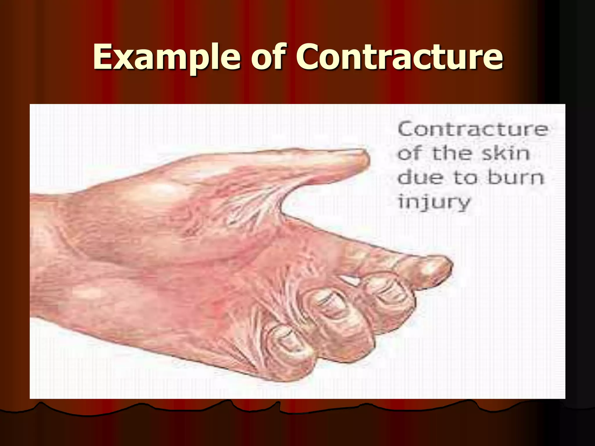 Example of Contracture
 