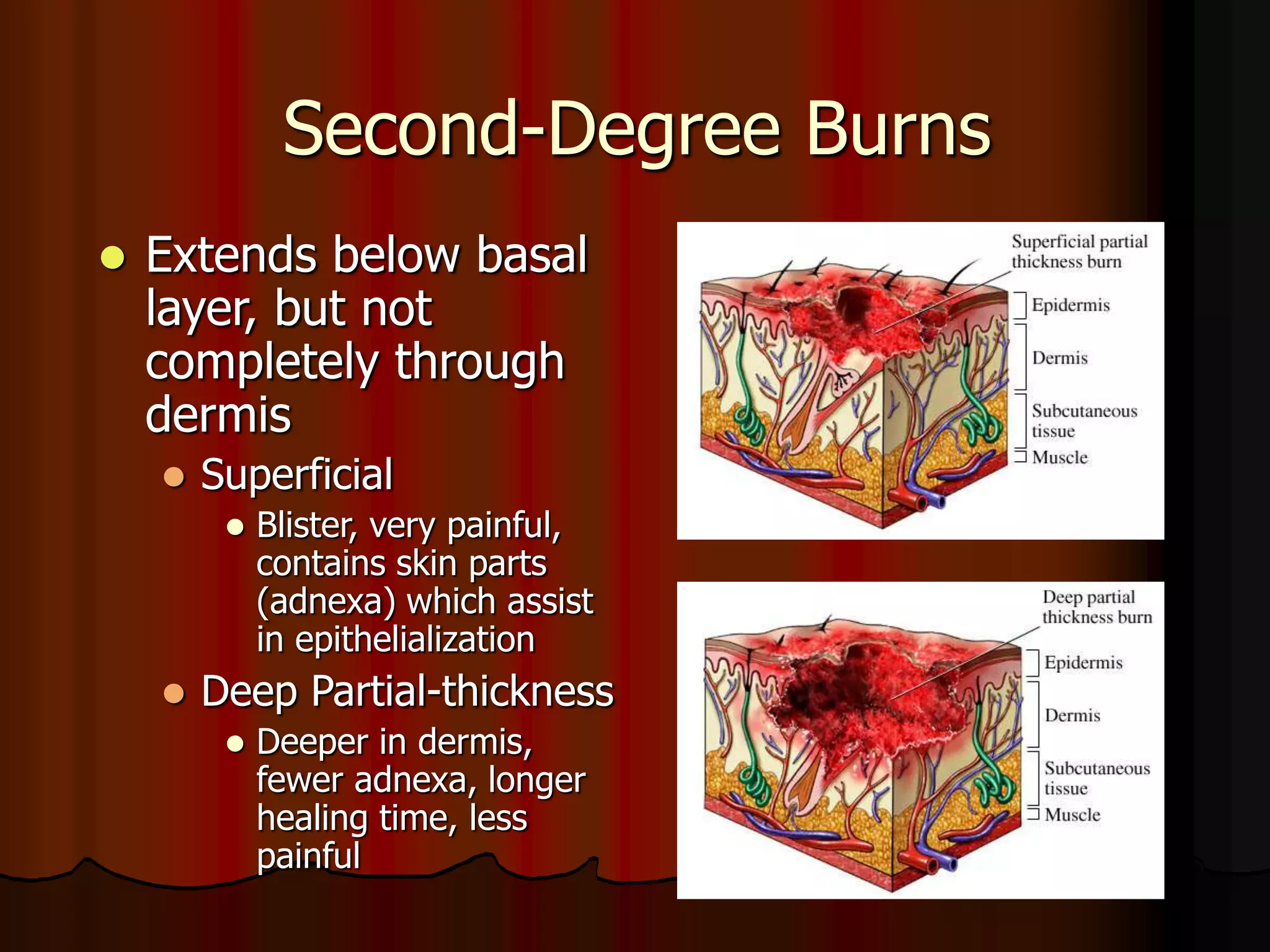 Second-Degree Burns
 Extends below basal
layer, but not
completely through
dermis
 Superficial
 Blister, very painful,
contains skin parts
(adnexa) which assist
in epithelialization
 Deep Partial-thickness
 Deeper in dermis,
fewer adnexa, longer
healing time, less
painful
 