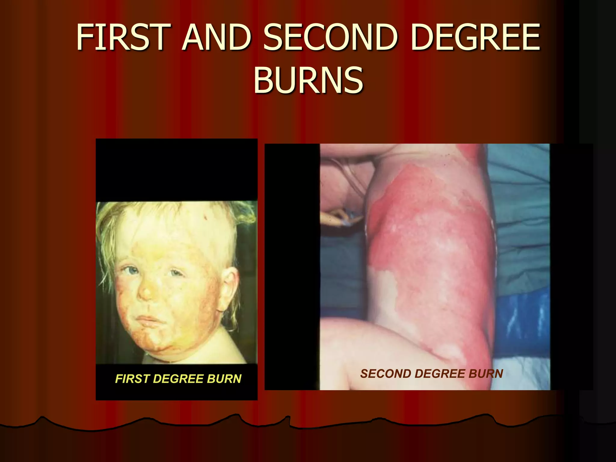 FIRST AND SECOND DEGREE
BURNS
FIRST DEGREE BURN SECOND DEGREE BURN
 