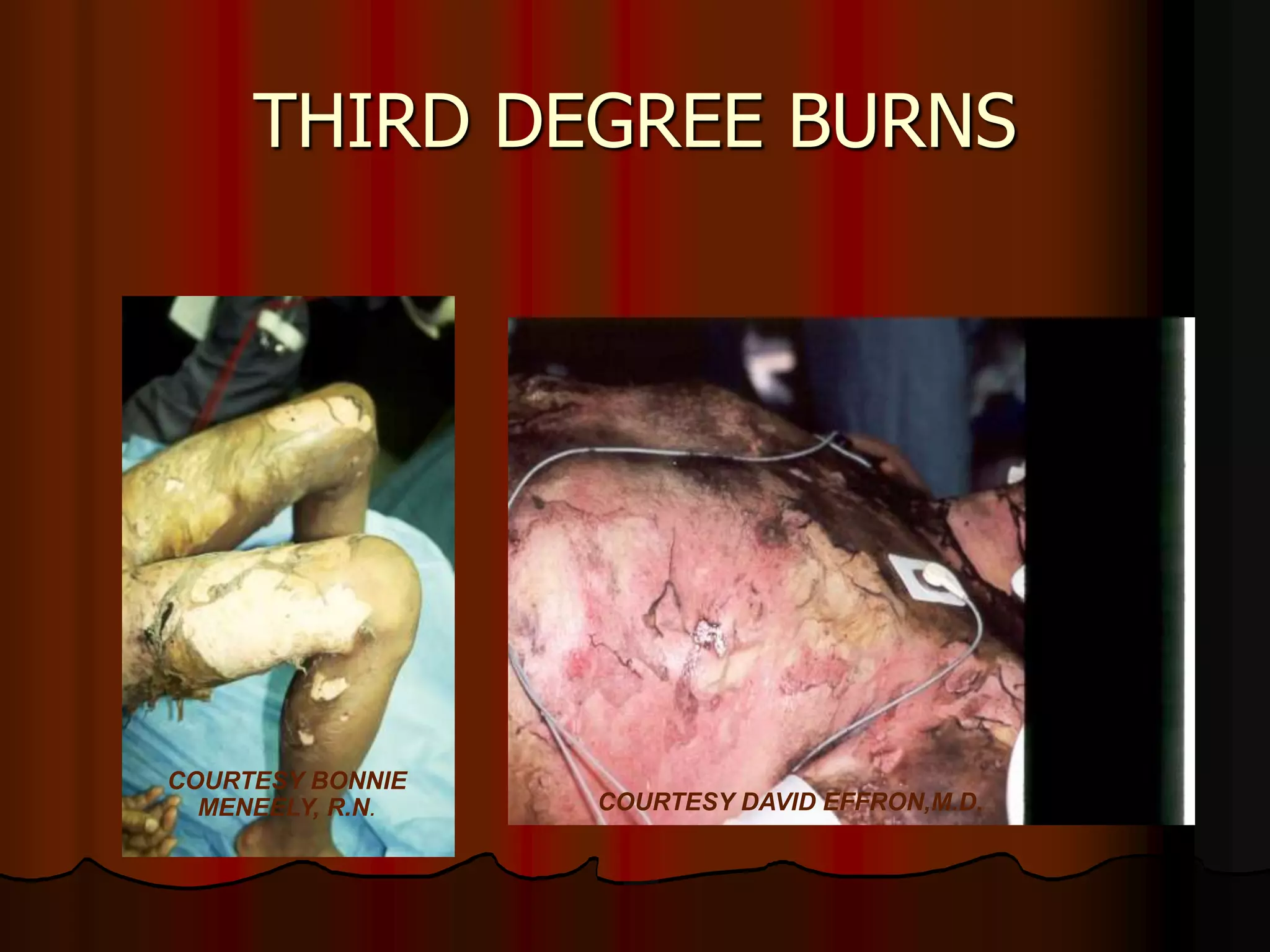 THIRD DEGREE BURNS
COURTESY DAVID EFFRON,M.D.
COURTESY BONNIE
MENEELY, R.N.
 