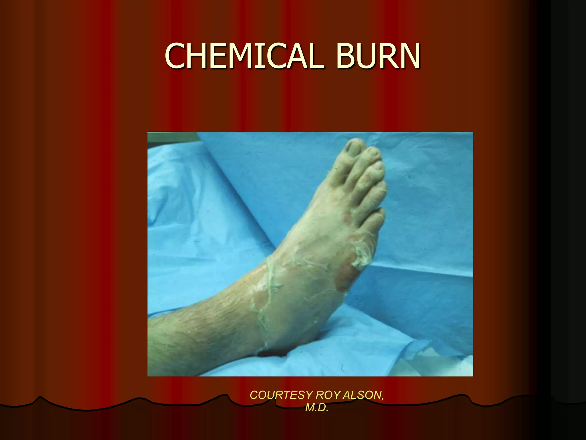 CHEMICAL BURN
COURTESY ROY ALSON,
M.D.
 