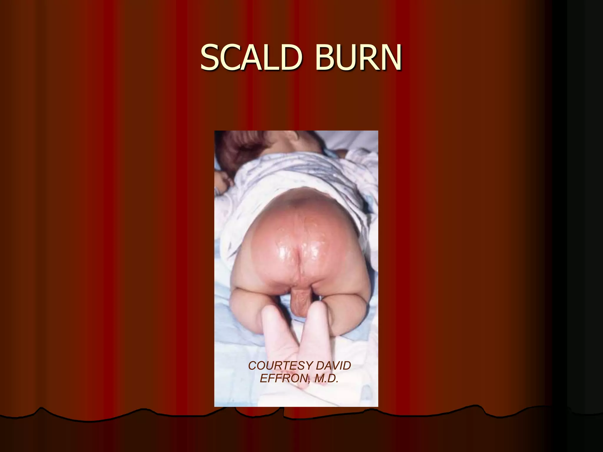 SCALD BURN
COURTESY DAVID
EFFRON, M.D.
 