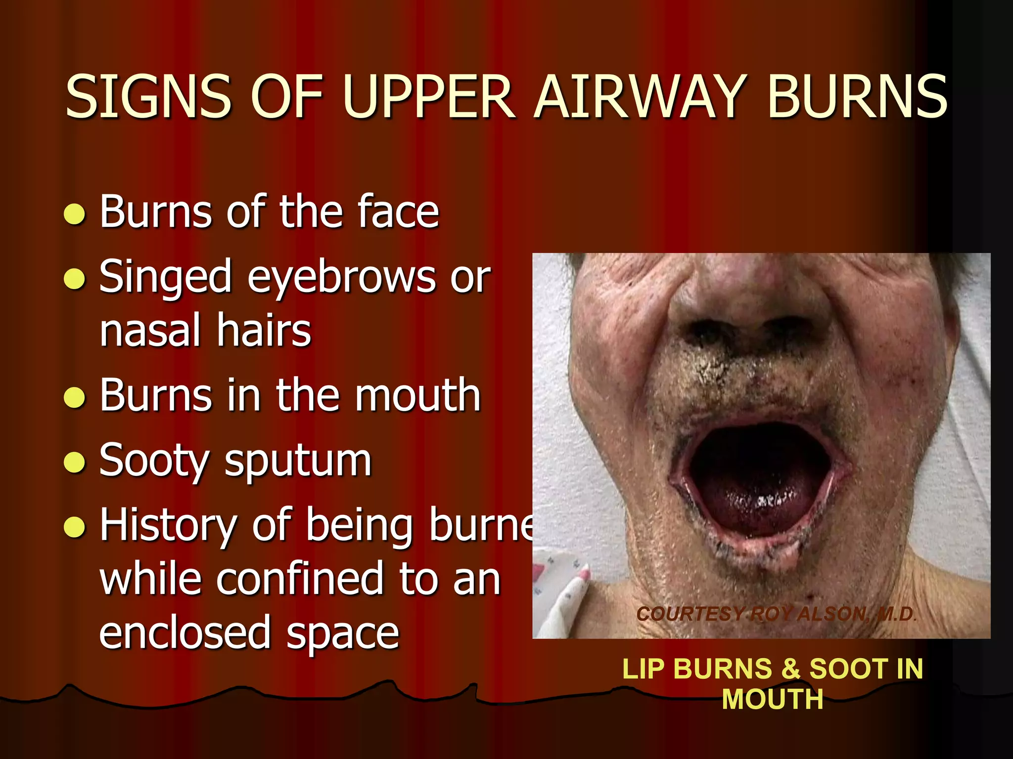 SIGNS OF UPPER AIRWAY BURNS
 Burns of the face
 Singed eyebrows or
nasal hairs
 Burns in the mouth
 Sooty sputum
 History of being burned
while confined to an
enclosed space
COURTESY ROY ALSON, M.D.
LIP BURNS & SOOT IN
MOUTH
 