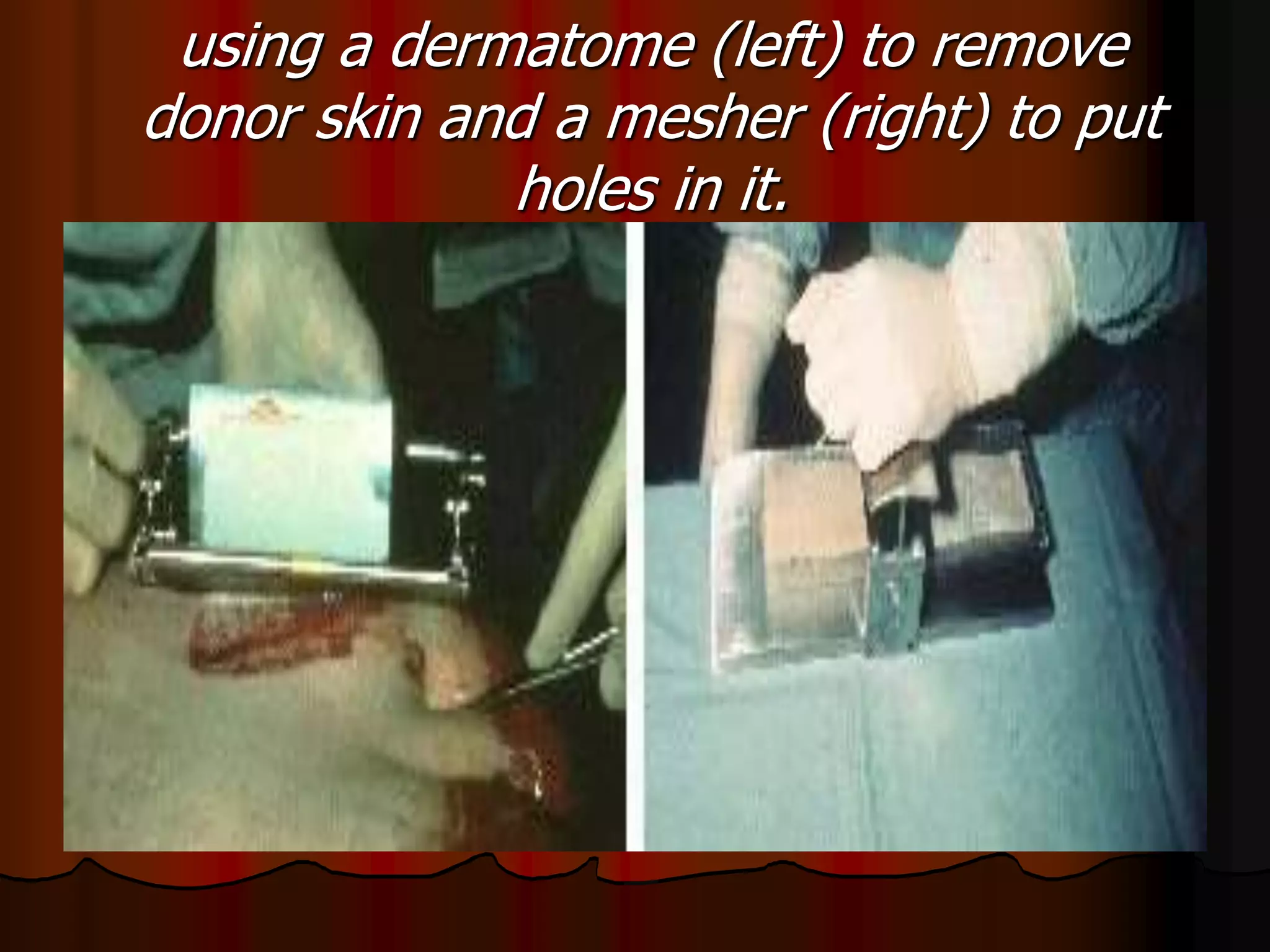 using a dermatome (left) to remove
donor skin and a mesher (right) to put
holes in it.
 
