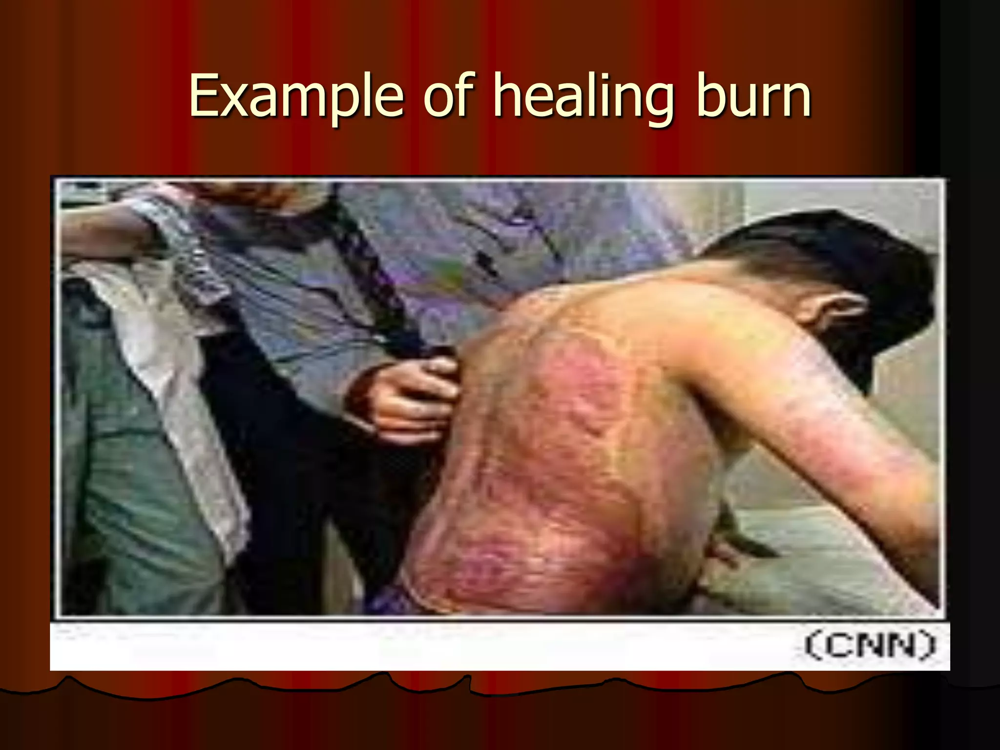Example of healing burn
 