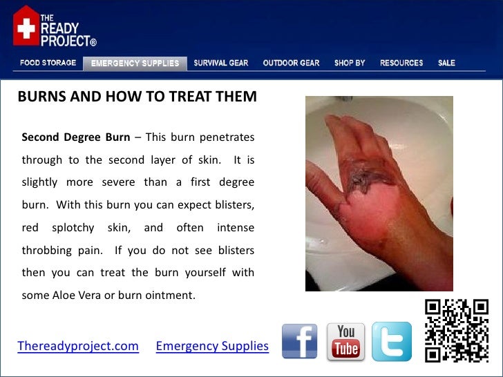a to treat burn how how to treat and them Burns a to treat burn how how to treat and them Burns