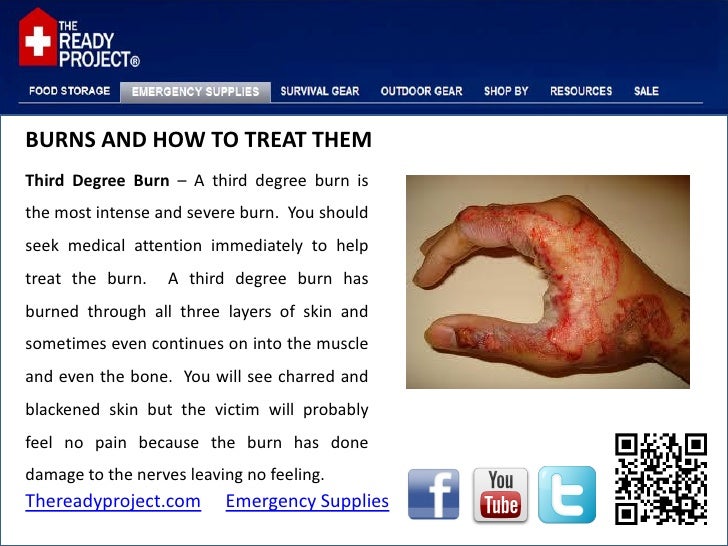 Burns and how to treat them