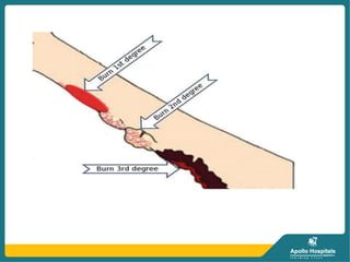 BURNS AND ITS MANAGEMENT.pptx PREPARED BY NEHA KEWAT | PPTX