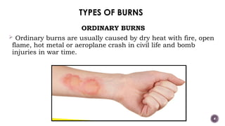 Burns and its types (classification) .pptx