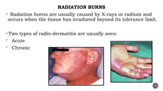 Burn Net Types Burns and its types (classification) .pptx