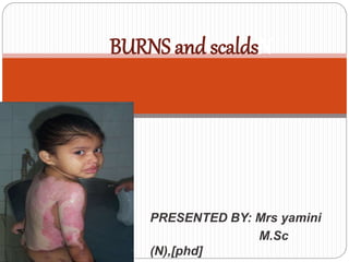 BURNS and scaldsN
PRESENTED BY: Mrs yamini
M.Sc
(N),[phd]
 