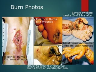 Burn Photos
Electrical Burns
Entrance Wounds
Electrical Burns
Exit Wounds
Entrance wound of electrical
burns from an overheated tool
Severe swelling
peaks 24-72 hrs after
Electrical burns mummified
1st
2 fingers later removed
 
