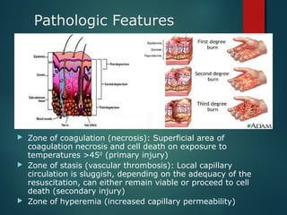 Pathologic Features
 Zone of coagulation (necrosis): Superficial area of
coagulation necrosis and cell death on exposure to
temperatures >450
(primary injury)
 Zone of stasis (vascular thrombosis): Local capillary
circulation is sluggish, depending on the adequacy of the
resuscitation, can either remain viable or proceed to cell
death (secondary injury)
 Zone of hyperemia (increased capillary permeability)
 