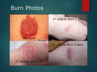 Burn Photos
Mild Burn
2nd
degree Burn 1 hr
2nd
degree Burn 1 day
2nd
degree Burn 2 days
 