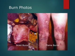 Burn Photos
Scald Burns Flame Burns
 