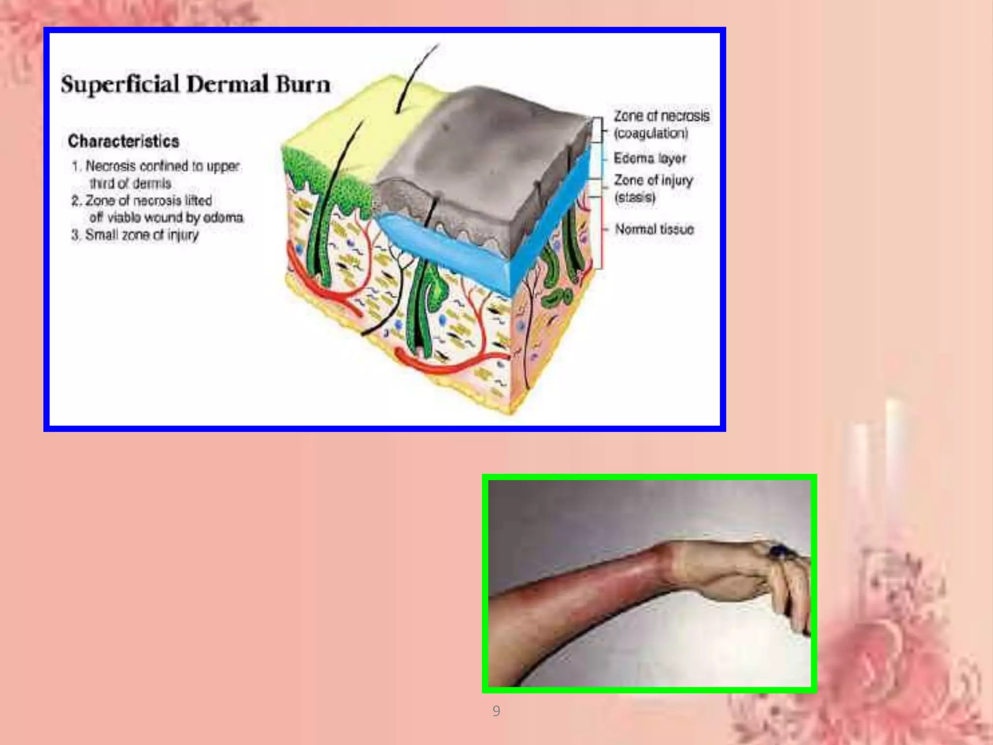 Nursing management of Burns