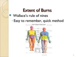 07/16/16 16
Extent of BurnsExtent of Burns
 Wallace’s rule of nines
◦ Easy to remember, quick method
 