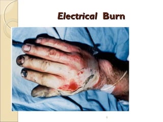 ElectricalElectrical BurnBurn
6
 