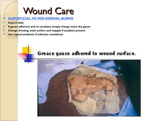 Wound CareWound Care
 SUPERFICIALTO MID-DERMAL BURNS
 Inspect daily
 If gauze adherent and no exudates, simply change outer dry gauze
 Change dressing, wash surface and reapply if exudates present
 Use topical antibiotic if infection considered
 