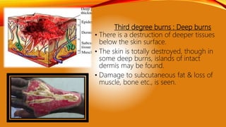 Third degree burns : Deep burns
• There is a destruction of deeper tissues
below the skin surface.
• The skin is totally destroyed, though in
some deep burns, islands of intact
dermis may be found.
• Damage to subcutaneous fat & loss of
muscle, bone etc., is seen.
 
