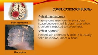 COMPLICATIONS OF BURNS:-
Heat haematoma:-
Haematoma may form in extra dural
space between skull & dura mater when
cranium is exposed to severe heat.
Heat rupture:-
Heated skin contracts & splits .It is usually
seen on elbows, knees & head
 